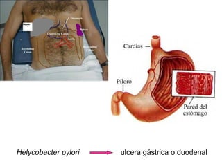 Helycobacter pylori ulcera gástrica o duodenal
 