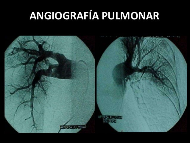 Resultado de imagen de AngiografÃa pulmonar