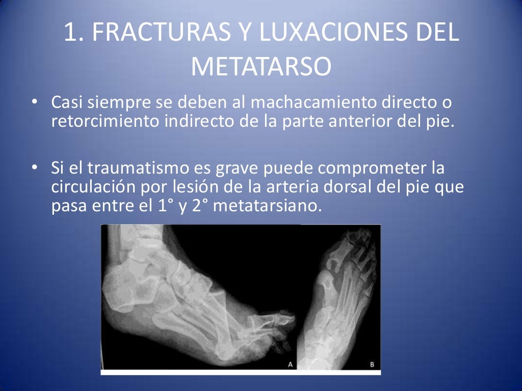 Fracturas del pie