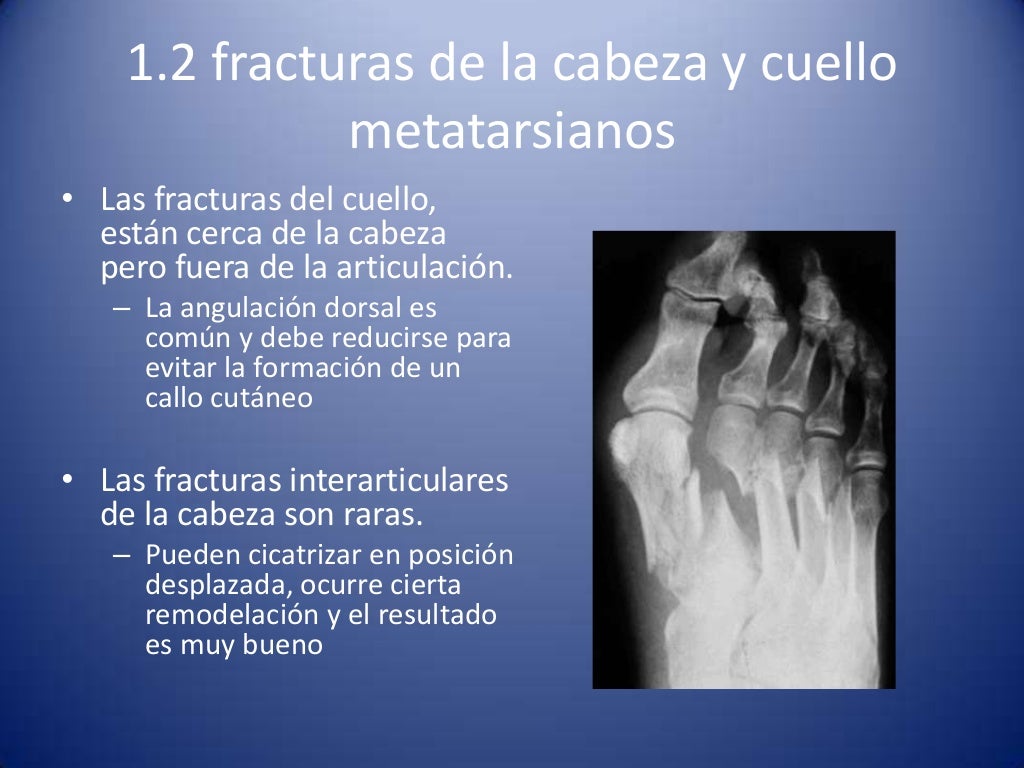 Fracturas del pie