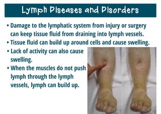 Lymph Diseases and Disorders
• If the cells of your tonsils become infected, your tonsils
will swell. This condition is tonsillitis.
 