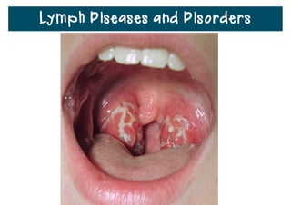 Lymph Diseases and Disorders
• The uncontrolled production of white blood cells is a
type of cancer called lymphoma.
• Cancer of the lymph nodes is a related disease called
Hodgkin’s lymphoma.
 