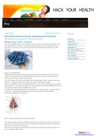 BlogBlog
« Back to Blog « Older Entry | Newer Entry »
Blue Waffle Disease? Causes, Symptoms And Treatment
Posted by joannasliwinska27@gmail.com on May 27, 2014 at 12:35 AM
What is Blue Waffle Disease?
The term “Blue Waffle Disease” is a not a disease in itself, but a term that was made up to describe a very
bad vaginal infection. It is also an “urban legend” that has spawned various photographs that are very
disgusting to say the least. To save your eyes, (See Figure 1) take a look at this picture for a bit softer
description.
Figure 1: Blue Waffle Disease
It appears that the name of the disease and the graphic pictures are only being used to draw internet
users to a website that gives only a brief explanation of the legend, some very unsettling pictures and
nothing else of use prove the disease actually exists.
The term comes from a few words put together that are actually slang. “Waffle” = slang term for vagina
and “Blue” = slang term used for the color of a very infected vagina lacking circulation.
There is no medical information on Blue Waffle Disease and no mention of the urban legend in any medical
documentation by major research hospitals. So, it is probably safe to say that Blue Waffle Disease does not
exist at all. But Sexually Transmitted Diseases are very real!
The claims in the urban legend state that the vagina takes on an “intense blue color.” Just take a look at
the anatomy of the female external reproductive area and see areas that could be affected by
discoloration or disfiguration. (See Figure 2)
Figure 2: Anatomy of Female External Reproductive Area
This could be the result of anything including; lack of blood flow to the labia, very rough sex or rape. The
claims also state that the disease can only be transferred from female to male, which doesn’t make sense
since how do women get it in the first place?
But to help you understand why this slang may be being used, let’s take a look at some symptoms of a
major unexplained vaginal infection.
Categories
Diet (21)
Disease (5)
weigh loss (13)
health tips (5)
age-related diseases (1)
skin care (1)
Men health (2)
women health (3)
HACK YOUR HEALTH
Home Blog About Photo Gallery Contact Videos Forums Guestbook
converted by Web2PDFConvert.com
 