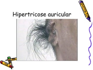 Hipertricose auricular 
 