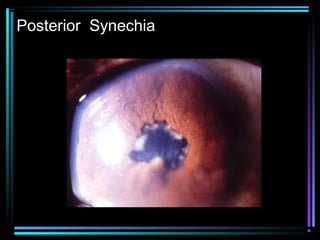 Uveitis | PPT