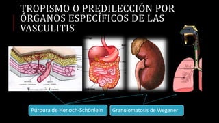 TROPISMO O PREDILECCIÓN POR
ÓRGANOS ESPECÍFICOS DE LAS
VASCULITIS
Granulomatosis de WegenerPúrpura de Henoch-Schönlein
 