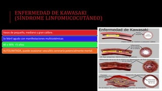 ENFERMEDAD DE KAWASAKI
(SÍNDROME LINFOMUCOCUTÁNEO)
Vasos de pequeño, mediano y gran calibre.
Sx febril agudo con manifestaciones multisistémicas
80 a 90% <5 años
AUTOLIMITADA, puede ocasionar vasculitis coronaria potencialmente mortal.
 