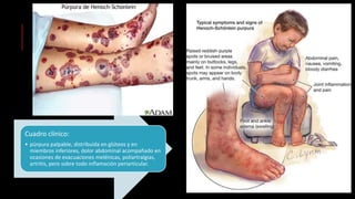 Cuadro clínico:
• púrpura palpable, distribuida en glúteos y en
miembros inferiores, dolor abdominal acompañado en
ocasiones de evacuaciones melénicas, poliartralgias,
artritis, pero sobre todo inflamación periarticular.
 