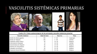 VASCULITIS SISTÉMICAS PRIMARIAS
 