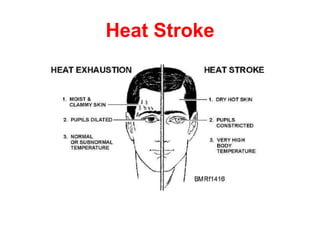Heat Stroke
 