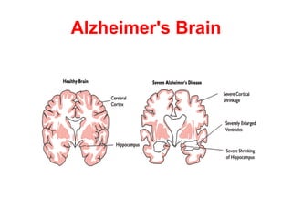Alzheimer's Brain
 