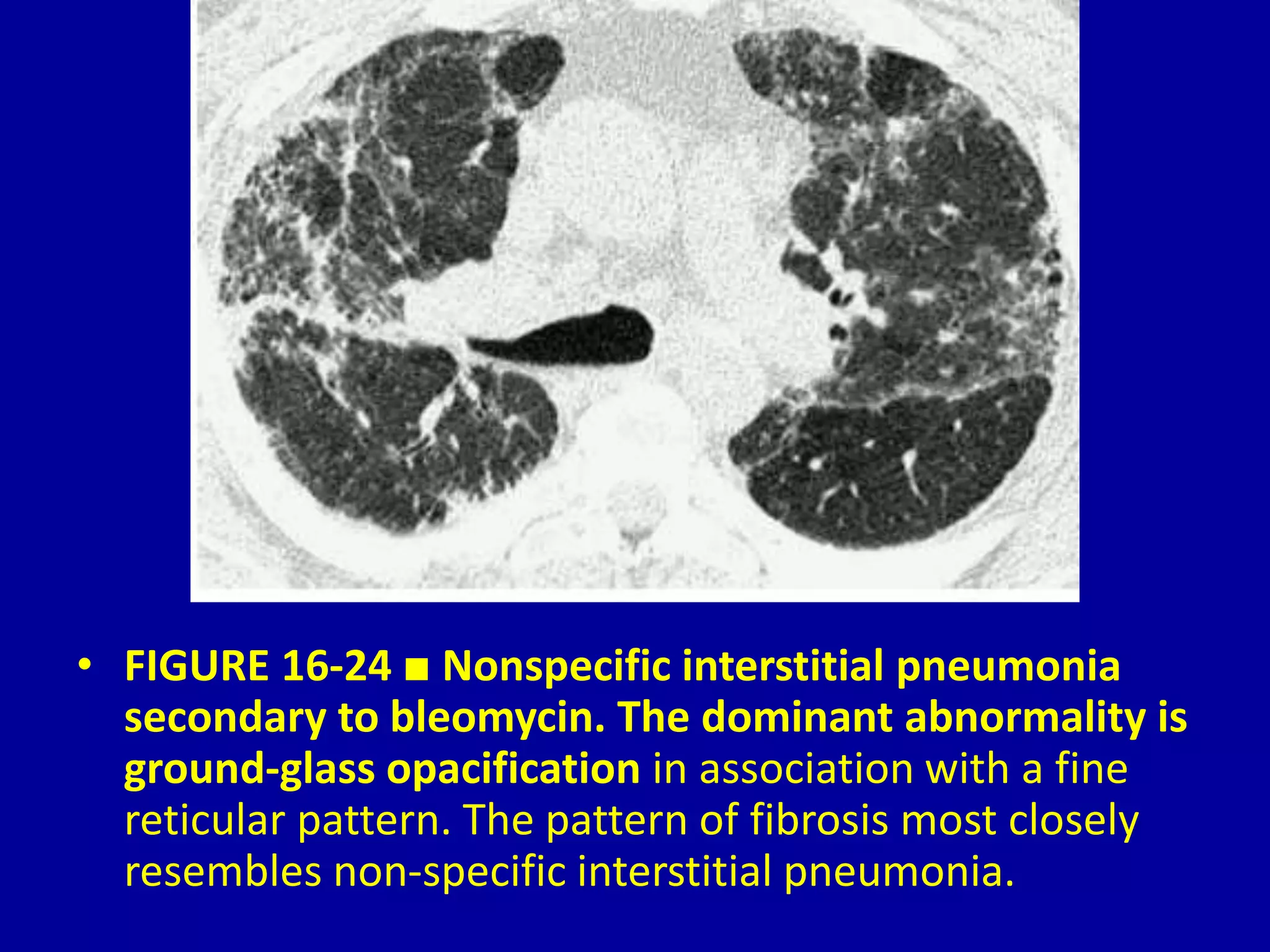 16 High Resolution Computed Tomography of Interstitial and Occupational ...