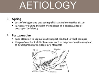 3. Ageing
 Loss of collagen and weakening of fascia and connective tissue
 Particularly during the post-menopause as a consequence of
oestrogen deficiency
4. Postoperative
 Poor attention to vaginal vault support can lead to vault prolapse
 Usage of mechanical displacement such as colposuspension may lead
to development of rectocele or enterocele
AETIOLOGY
 
