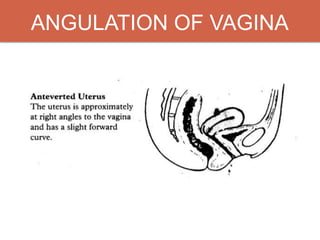 ANGULATION OF VAGINA
 