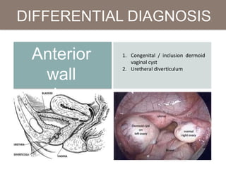 DIFFERENTIAL DIAGNOSIS
Anterior
wall
prolapse
1. Congenital / inclusion dermoid
vaginal cyst
2. Uretheral diverticulum
 