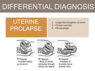 DIFFERENTIAL DIAGNOSIS
UTERINE
PROLAPSE
1. Congenital elongation of cervix
2. Chronic inversion
3. Fibroid polyps
 