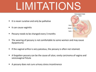 LIMITATIONS
 It is never curative and only be palliative
 It can cause vaginitis
 Pessary needs to be changed every 3 months
 The wearing of pessary is not comfortable to some women and may cause
dyspareunia
 If the vaginal orifice is very patulous, the pessary is often not retained.
 A forgotten pessary can be the cause of ulcer, rarely carcinoma of vagina and
vesicovaginal fistula
 A pessary does not cure urinary stress incontinence
 