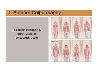1. Anterior Colporrhaphy
To correct cystocele &
urethrocele or
cystourethrocele
 