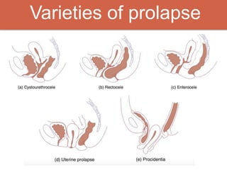 Varieties of prolapse
 