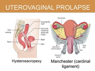 UTEROVAGINAL PROLAPSE
Hysterosacropexy Manchester (cardinal
ligament)
 