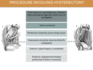 PROCEDURE INVOLVING HYSTERECTOMY
Third clamp on round ligament, fallopian
tube and ovarian ligament which are cut
and ligated
Uterus removed
Peritonium closed by purse string suture
Enterocele correction done by McCall’s
culdoplasty
Anterior colporrhaphy is completed
Posterior colpoperineorrhaphy
performed if there is rectocele
 
