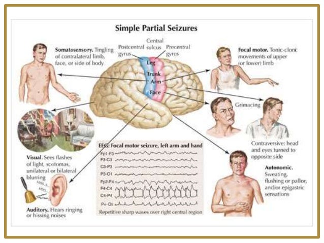 Epilepsy Headache And Facial Pain Epilepsy Headache And Facial Pain
