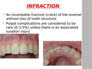 Enamel Infarctions traumatic injuries to teeth | PDF