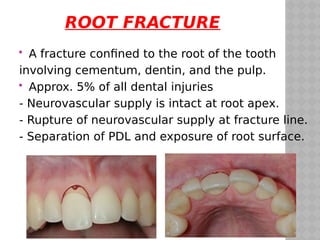 traumatic injuries to teeth | PDF