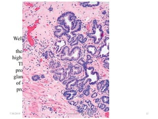 16. symposium adenocarcinoma esophagus | PPT