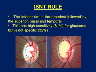 ISNT RULE
• The inferior rim is the broadest followed by
the superior, nasal and temporal
• This has high sensitivity (81%) for glaucoma
but is not specific (32%)
 