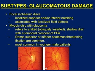 SUBTYPES: GLAUCOMATOUS DAMAGE
• Focal ischaemic discs
- localized superior and/or inferior notching
- associated with localized field defects
• Myopic disc with glaucoma
- refers to a tilted (obliquely inserted), shallow disc
with a temporal crescent of PPA
- Dense superior or inferior scotomas threatening
fixation are common.
- most common in younger male patients.
 