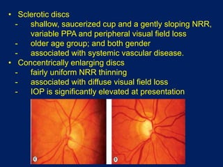 • Sclerotic discs
- shallow, saucerized cup and a gently sloping NRR,
variable PPA and peripheral visual field loss
- older age group; and both gender
- associated with systemic vascular disease.
• Concentrically enlarging discs
- fairly uniform NRR thinning
- associated with diffuse visual field loss
- IOP is significantly elevated at presentation
 