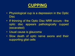 CUPPING
• Physiological cup is a depression in the Optic
Disc
• If thinning of the Optic Disc NRR occurs - the
optic disc appears pathologically cupped
(excavated)
• Usual cause is glaucoma
• Slow death of optic nerve axons and their
supporting glial cells
 