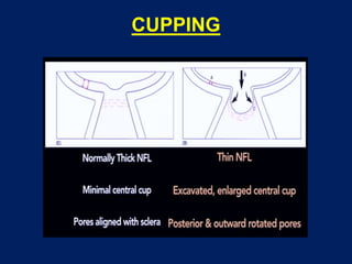 CUPPING
 