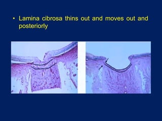 • Lamina cibrosa thins out and moves out and
posteriorly
 