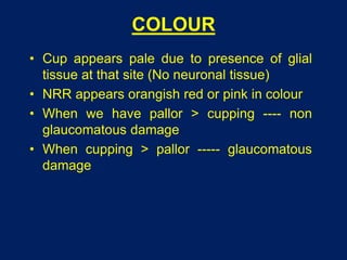 COLOUR
• Cup appears pale due to presence of glial
tissue at that site (No neuronal tissue)
• NRR appears orangish red or pink in colour
• When we have pallor > cupping ---- non
glaucomatous damage
• When cupping > pallor ----- glaucomatous
damage
 