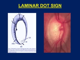 LAMINAR DOT SIGN
 