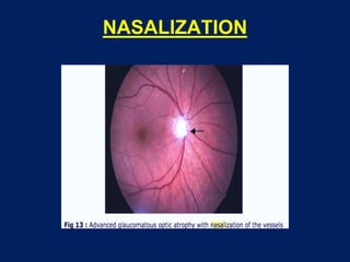 NASALIZATION
 