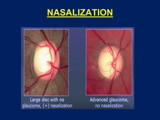 NASALIZATION
 