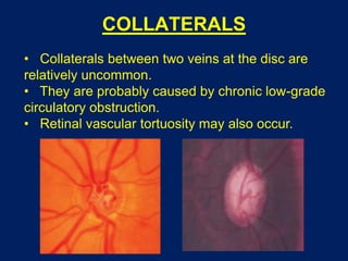 COLLATERALS
• Collaterals between two veins at the disc are
relatively uncommon.
• They are probably caused by chronic low-grade
circulatory obstruction.
• Retinal vascular tortuosity may also occur.
 