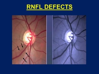RNFL DEFECTS
 