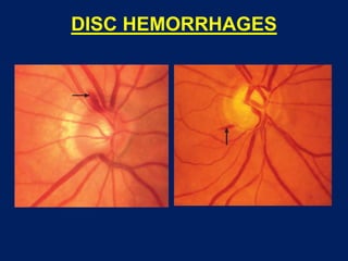 DISC HEMORRHAGES
 