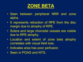 ZONE BETA
• Seen between peripheral NRR and zone
alpha.
• It represents retraction of RPE from the disc
margin due to atrophy of RPE.
• Sclera and large choroidal vessels are visible
due to RPE atrophy.
• Location and extent of zone beta atrophy
correlates with visual field loss.
• Indicates area has poor perfusion
• Seen in POAG and NTG.
 