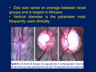 • Disc size varies on average between racial
groups and is largest in Africans
• Vertical diameter is the parameter most
frequently used clinically
 