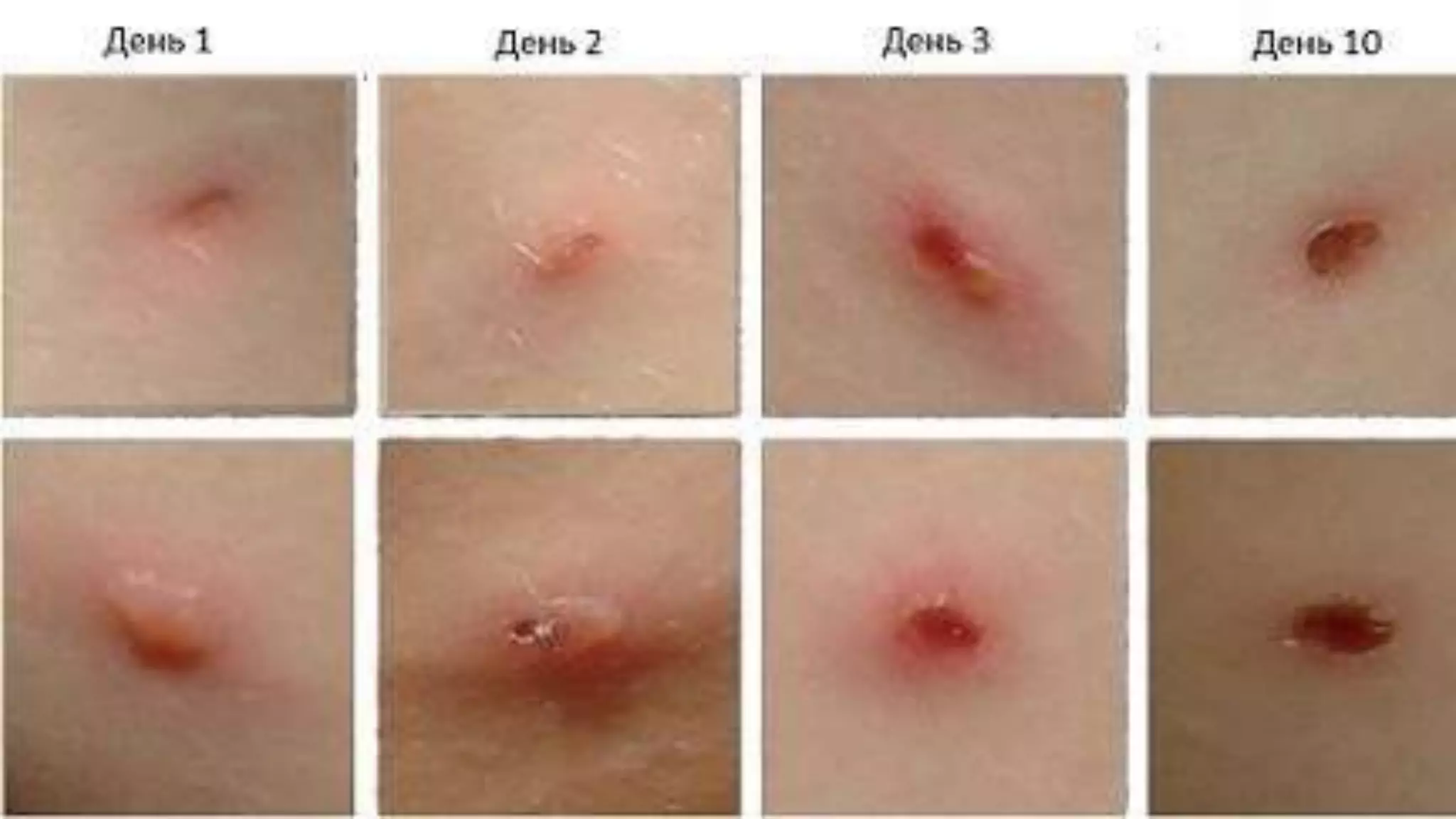 Лекція Вітряна віспа Скарлатина .pptx