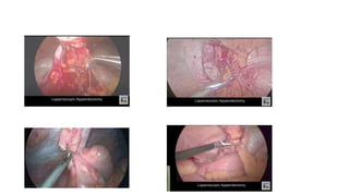 16. laparascopic appendectomy 1.pptx