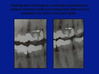 16.Role of dental calculus.ppt