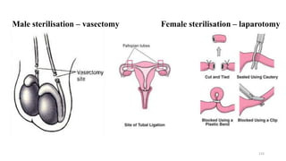 133
Male sterilisation – vasectomy Female sterilisation – laparotomy
 