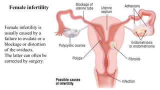 135
Female infertility
Female infertility is
usually caused by a
failure to ovulate or a
blockage or distortion
of the oviducts.
The latter can often be
corrected by surgery.
 