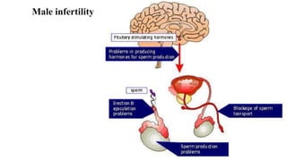 Male infertility
 